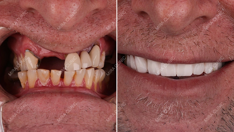 Before and After: Real Dental Implant Result